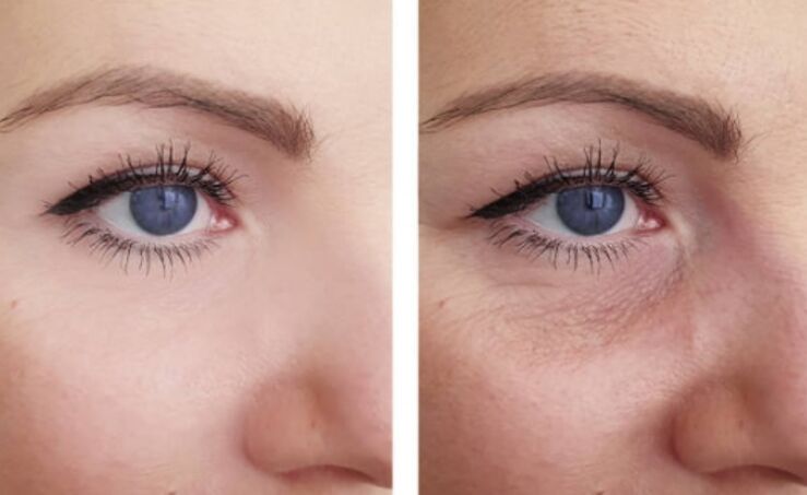 vor und nach der Plasmaverjüngung um die Augen