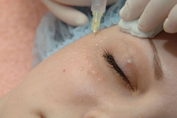 Mesotherapie - eine Injektionsmethode zur Verjüngung der Gesichtshaut