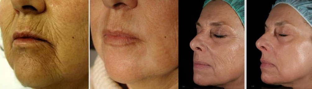 Gesichtshaut vor und nach der Laserverjüngung