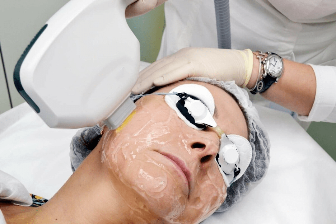 Laserverjüngung für die Gesichtshaut