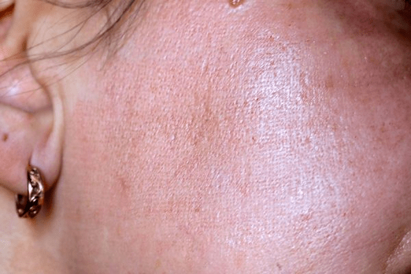 Rötung der Haut nach Laserverjüngung